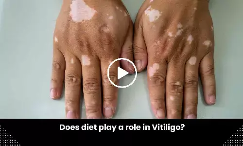 Does diet play a role in Vitiligo? Study finds out