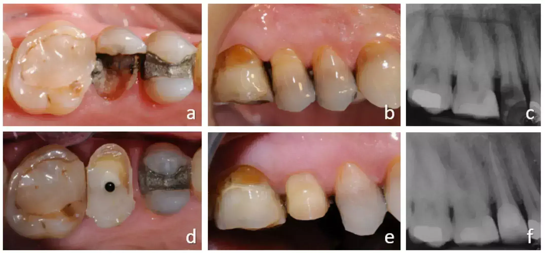 Loss of tooth structure, vertical root fracture and periodontal disease tied to extraction of root canal-treated teeth: Study
