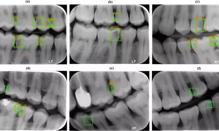 Artificial intelligence may help detect proximal caries on bitewing x-ray, reveals study