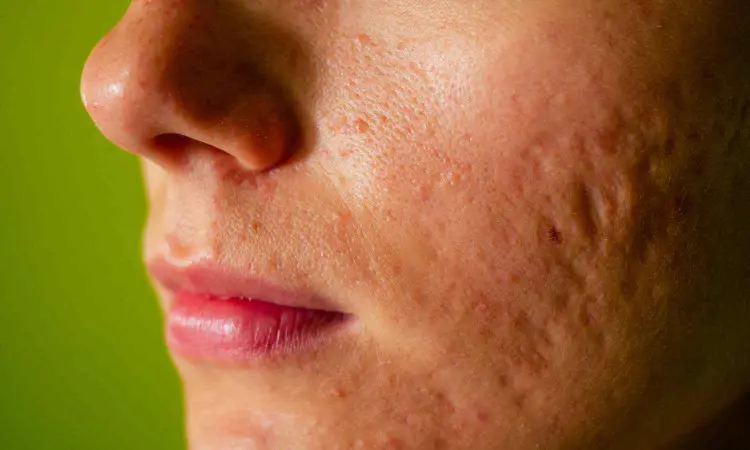 New wavelength-dependent indicators improve efficacy of spot-on laser treatment for skin blemishes: Study