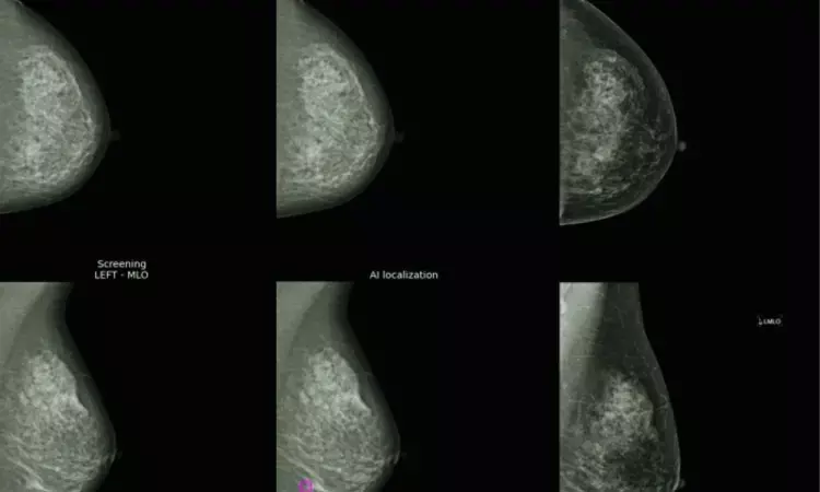 AI effectively detects interval breast cancer in subsequent two years post-screening by mammograms: Study