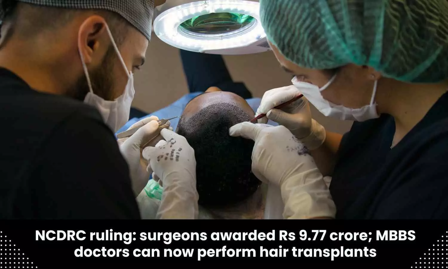No medical negligence during hair transplant procedure: NCDRC exonerates Hair Transplant Clinic, two surgeons