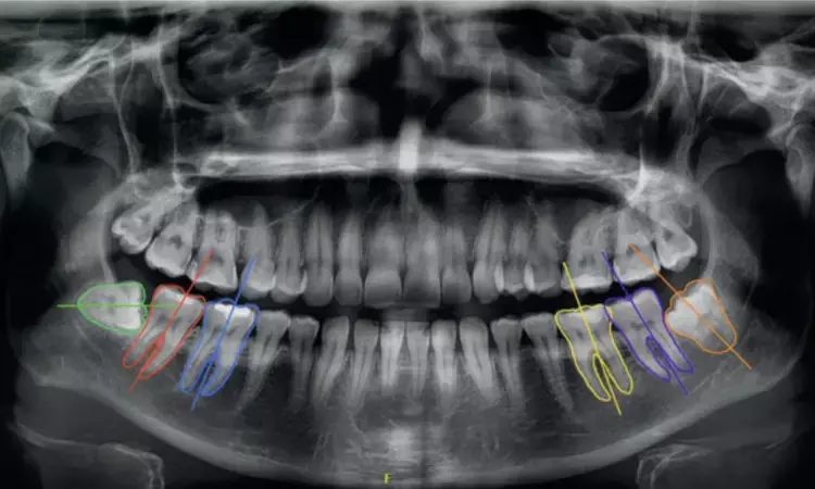 AI system improves accuracy of CBCT images for implant placement, third molar extraction and orthognathic surgery: Study