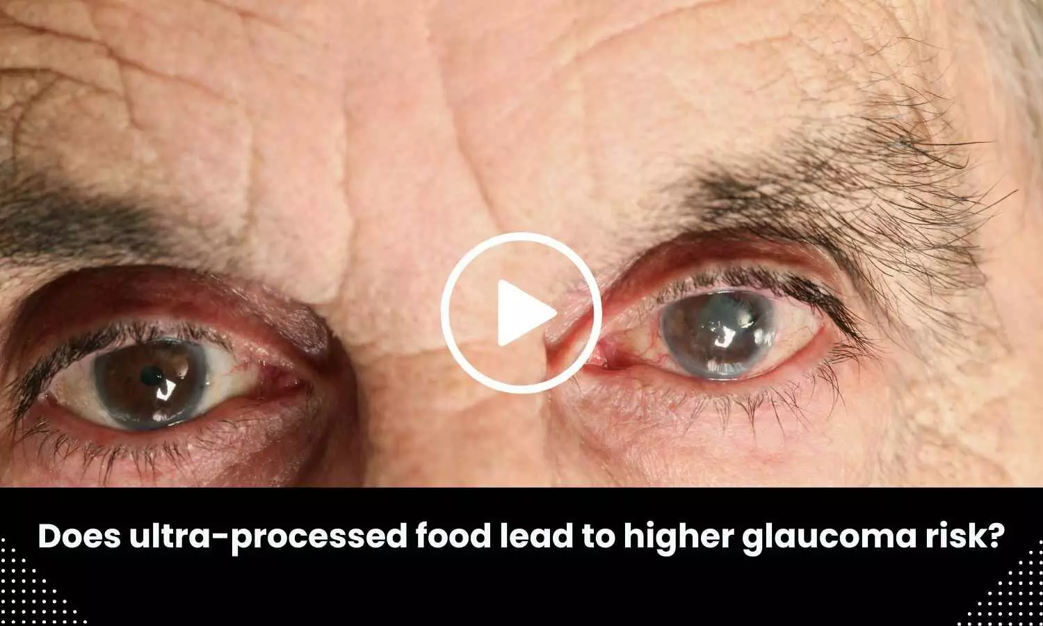 Does ultra-processed food lead to higher glaucoma risk?