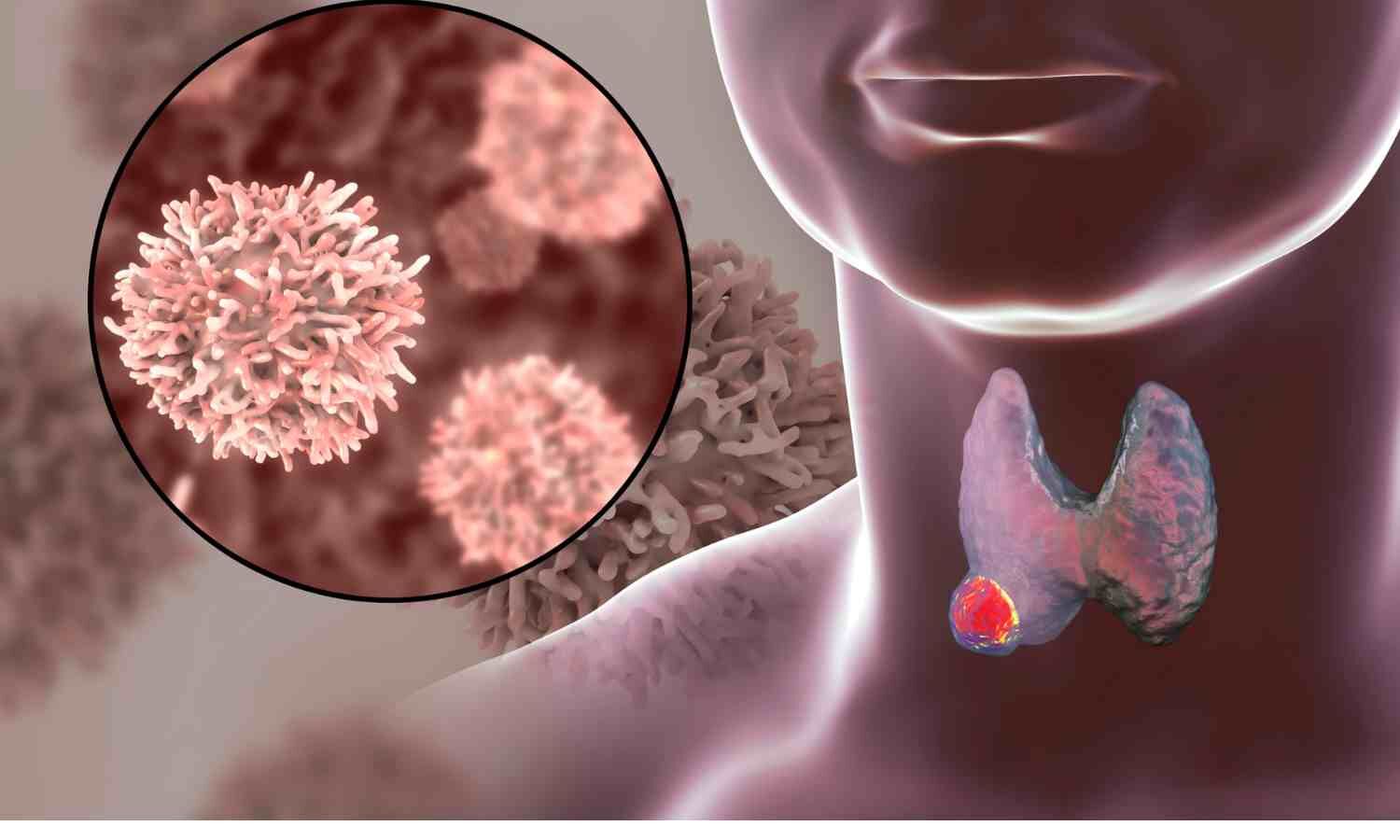 GLP 1RA AND THYROID CANCER NEW STUDY SUGGESTS DETECTION BIAS NOT visual data 6