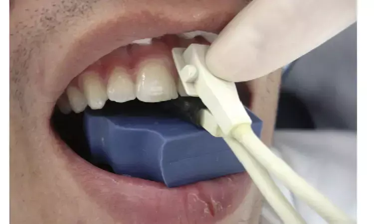 Oxygen saturation testing effective tool to evaluate pulp status of avulsed teeth after replantation: Study