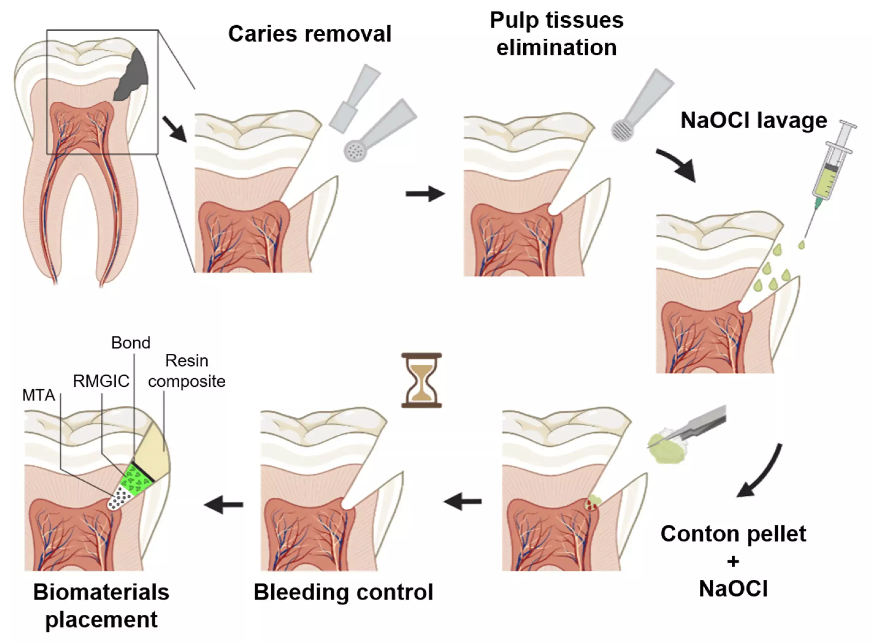 Full pulpotomy bests partial pulpotomy for managing of spontaneous symptomatic pulpitis: Study