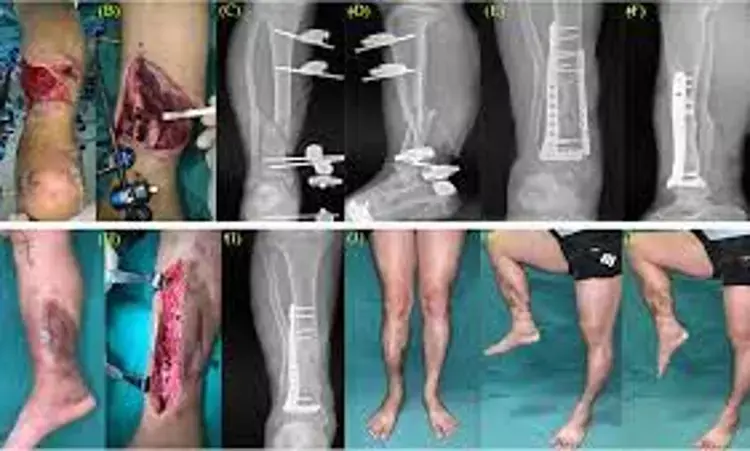 Masquelet technique and double plate fixation combo effectively treats large segmental bone defects of distal tibia: Study