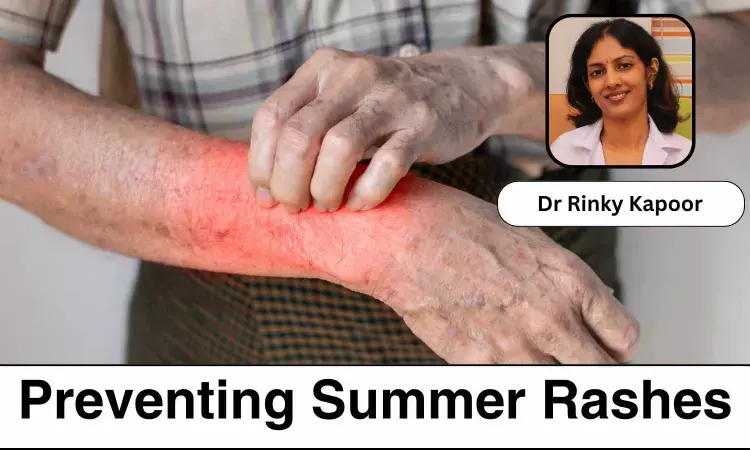How To Prevent and Treat Summer Rashes? - Dr Rinky Kapoor