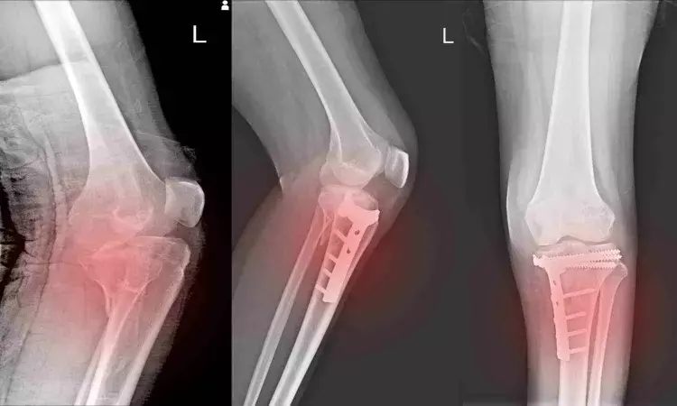 Non-thermal atmospheric-pressure plasma novel approach to treatment of bone fractures: Study