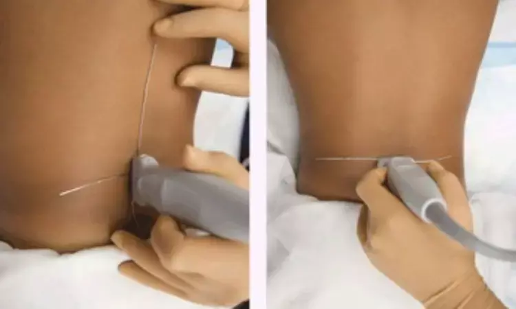 Traditional landmark-based lumbar puncture as effective as ultrasound-guided LP in outpatient settings: UltraGUD LP study