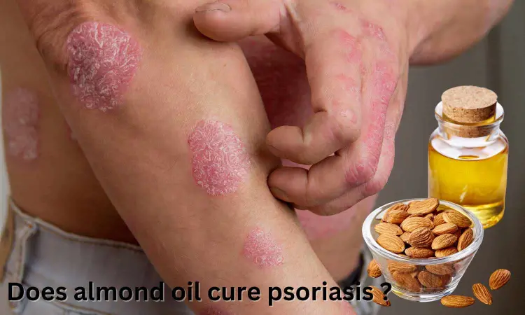 Fact Check: Does almond oil cure Psoriasis?