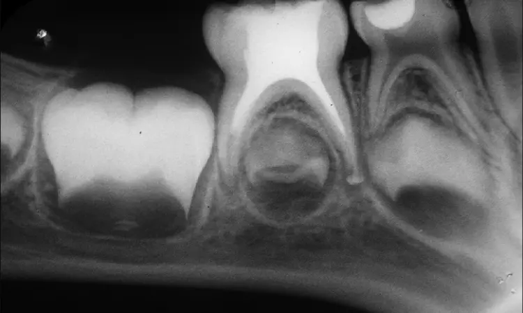 Ginge-Cal promising material for treatment of infected root canal when used as obturation material: Study