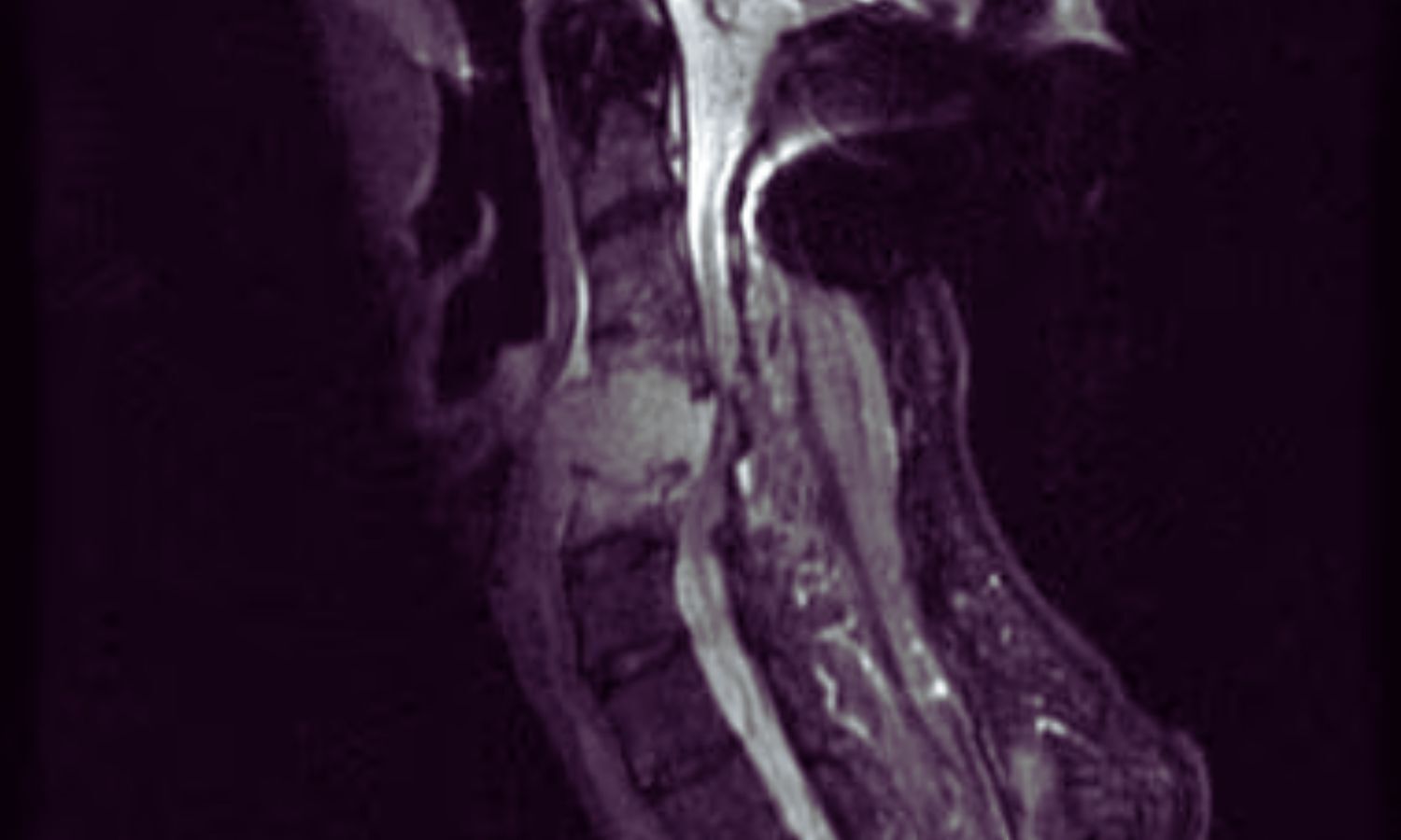 PET/CT technique revolutionizes spinal bone metastases detection in ...
