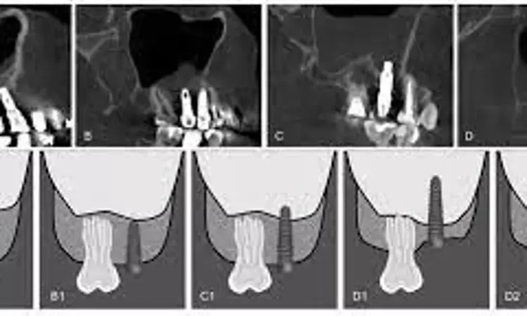Implant failure rate and risk of sinusitis low for implants penetrating floor of maxillary sinus, reveals study