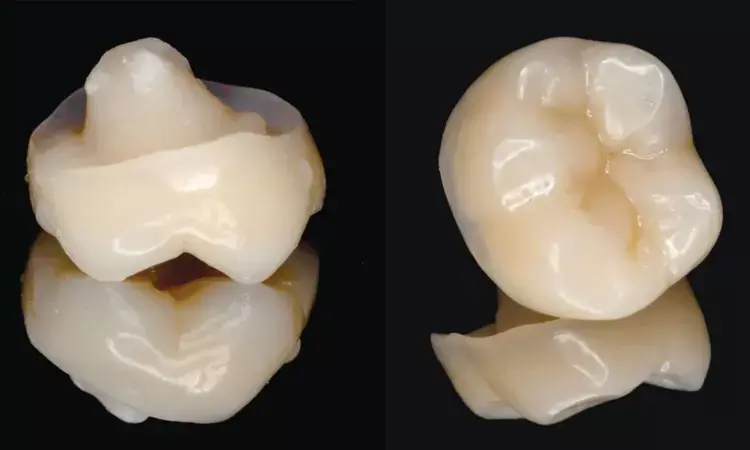 Does material of endocrowns matter for successful restoration of endodontically treated teeth? Study draws comparison