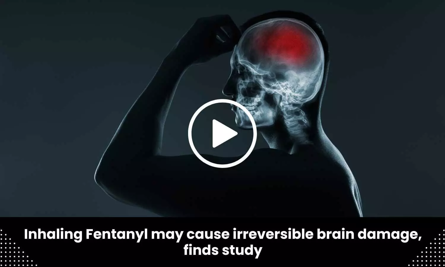 Inhaling Fentanyl may cause irreversible brain damage, finds study