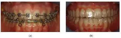 Both water jet flossing and interdental flossing  reduce plaque accumulation and gingival bleeding among orthodontic patients: Study