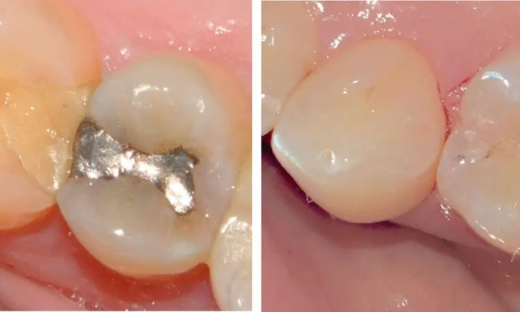 A Year-Long Clinical Study Compares Self-Adhesive and Conventional Bulk-Fill Composites in Class II Cavities