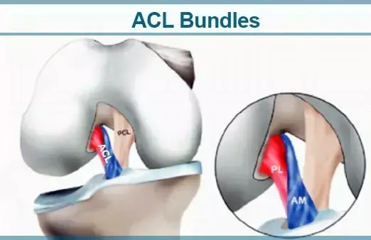 Double bundle ACL reconstruction tied to better IKDC objective grading at 15 year follow up compared to single bundle reconstruction: study