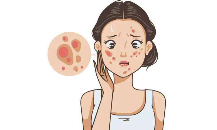 Triple-combination gel therapy for acne effective in achieving skin clearance: Study