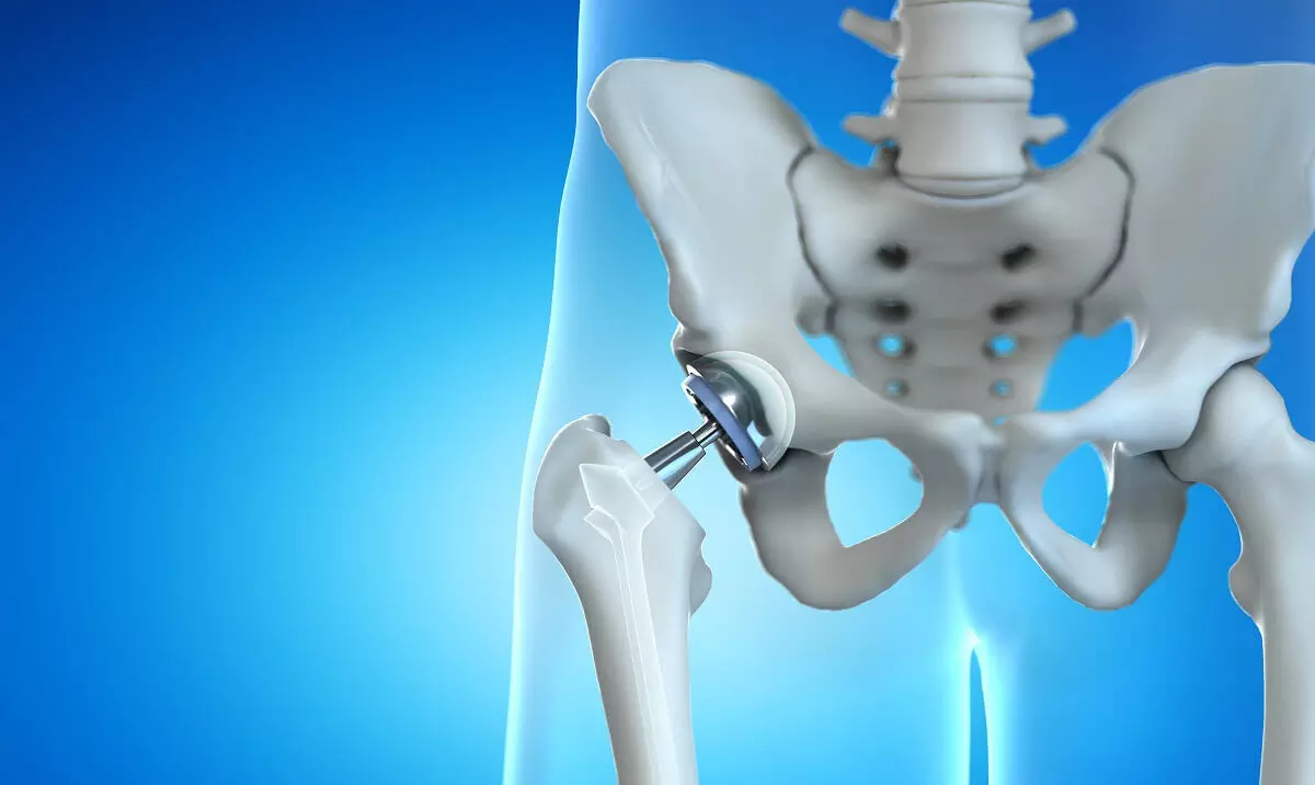 High femoral offset has 3.7-fold increased probability for aseptic femoral component loosening: study