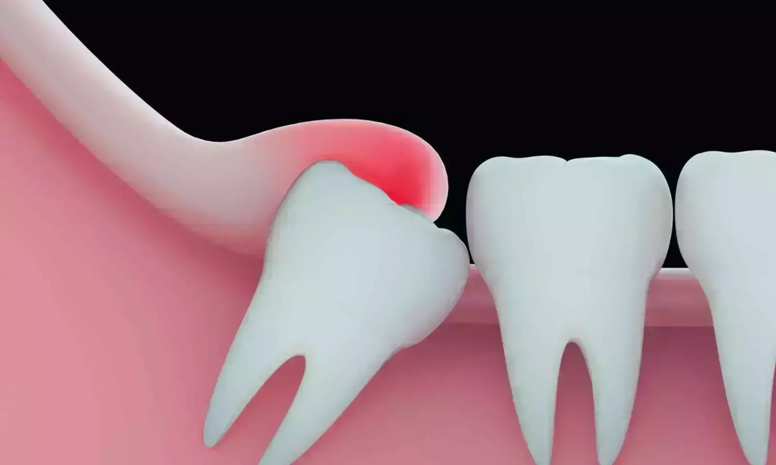 Peripheral Nerve Stimulator-guided extraoral mandibular nerve block effective for molar extractions: Study