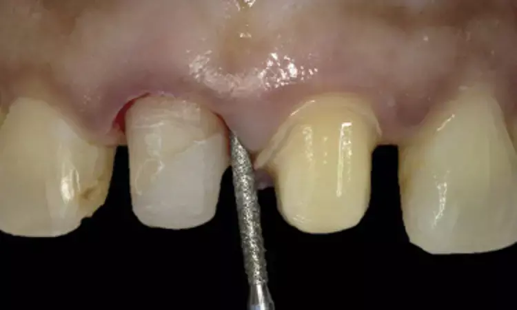 Use of restorations on vertically prepared teeth suitable option to classical horizontal preparations: Study