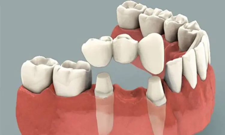 Innovations in Dentistry: Monolithic zirconia fixed partial dentures with flexible connectors solve abutment teeth