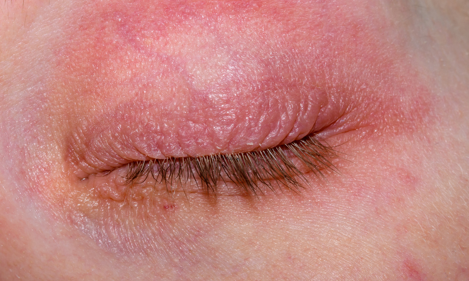 Nickel sulfate most common allergen in patients with eyelid dermatitis ...