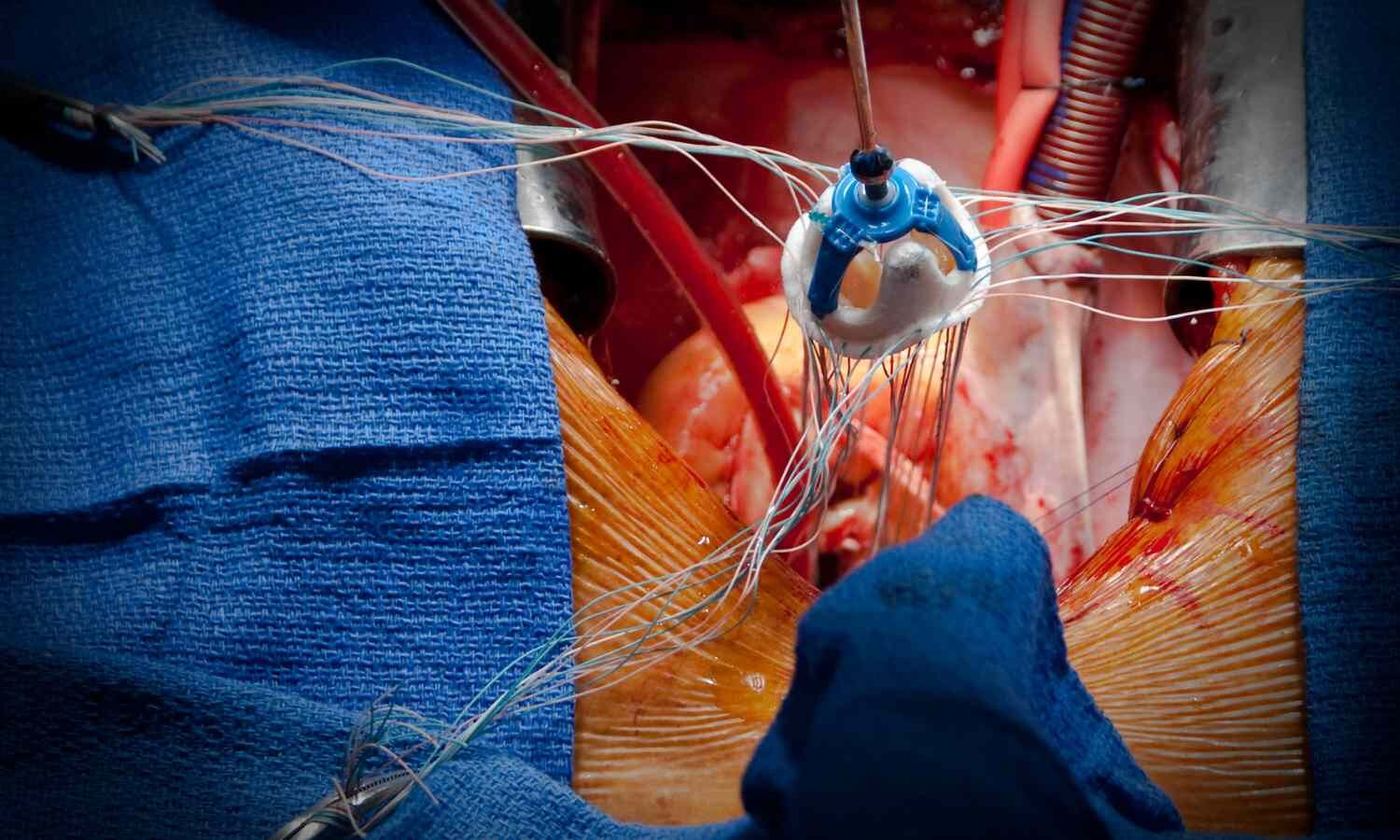 Study details Novel Strategy for Failed Mechanical Heart Valves: Device Fracture Followed by Valve-in-Valve Therapy