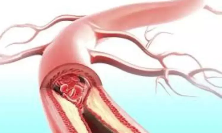 Study Reveals Link Between Coronary Atherosclerotic Plaque Activity and Myocardial Infarction Risk