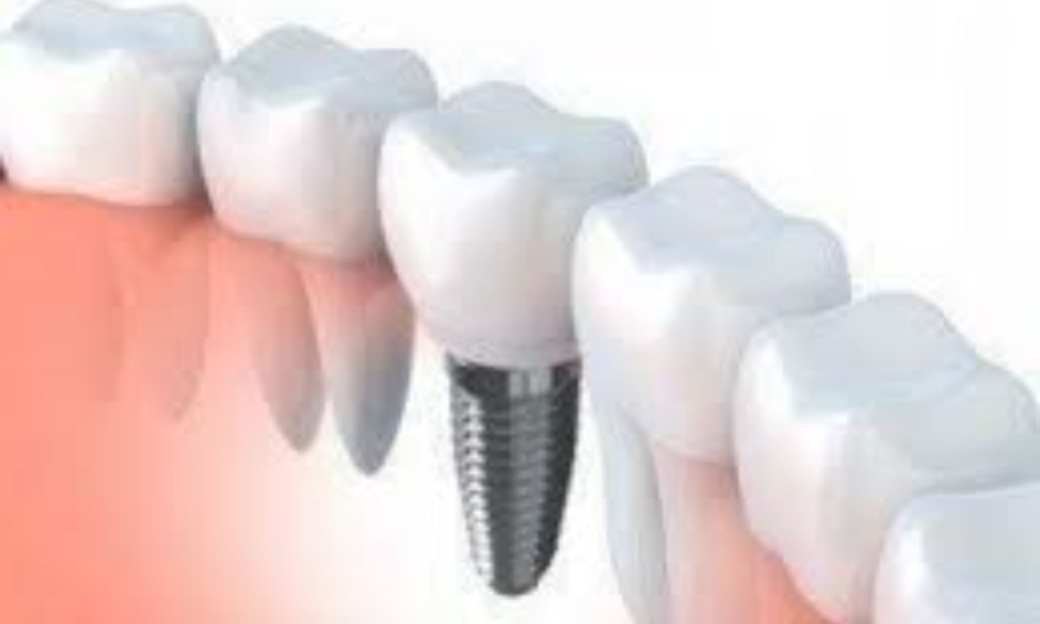 Magnesium Coating on Titanium Implants Enhances Early Osseointegration: Study