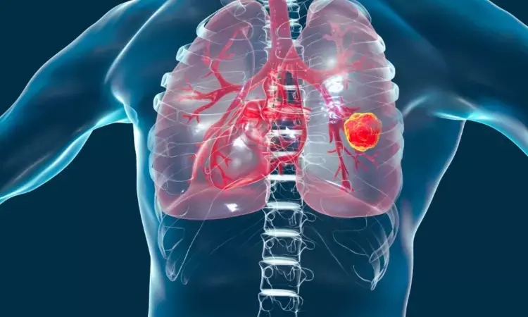 Ground-glass opacities on CT lung cancer imaging encouraging prognostic factor in non-small cell lung cancer: Study