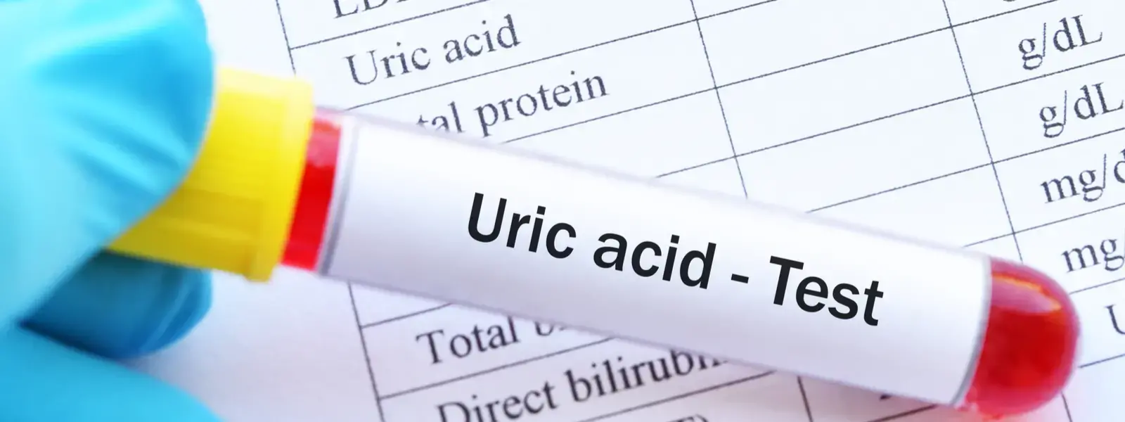 New study fails to establish correlation between Uric acid levels and Erectile dysfunction