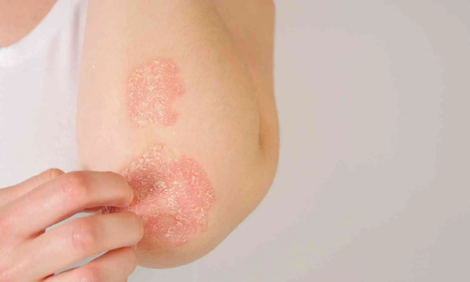 Drug used to treat eczema may provide relief for patients with intensely itchy skin diseases: JAMA