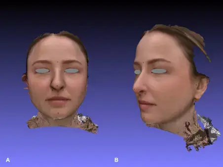 Digital face scanning reliable method for measuring changes in vertical dimension of occlusion, suggests study