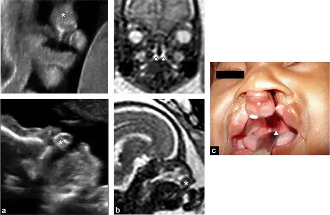 MRI could significantly improve precision of diagnosing cleft lip and palate, reveals study