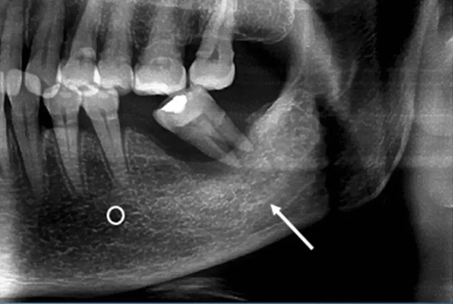 Tooth extraction significant risk factor for osteoradionecrosis, particularly when post-extraction sockets receive high RT dosage: Study