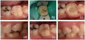 Ceramic chairside-fabricated endo crowns of various materials effectively restore endodontically treated molars and premolars: Study