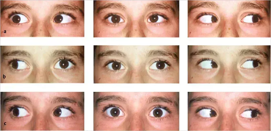 Bilateral medial rectus muscle injection with Botox safe and low-cost alternative for partially accommodative esotropia: Study