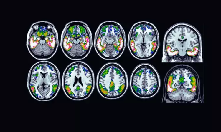 Tau Positron Emission Tomography Breakthrough in Predicting Dementia in Mild Cognitive Impairment Patients: JAMA