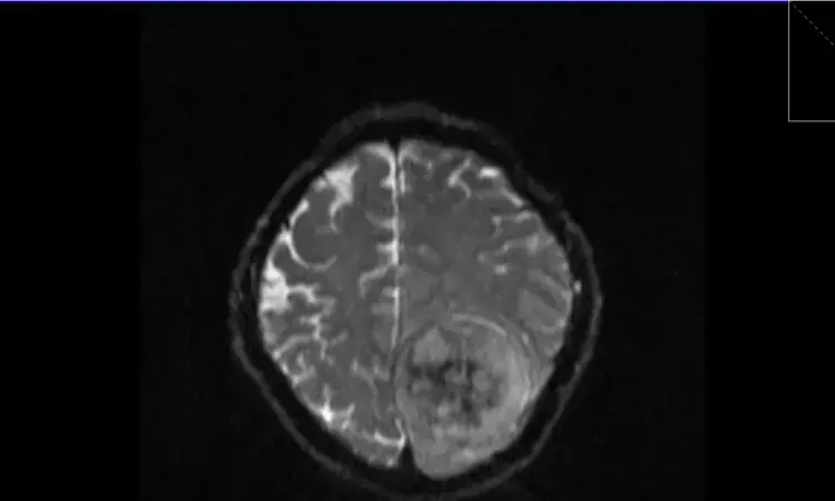 Advancements in MR Imaging: Study Explores Lower Gadolinium Doses for Meningioma Diagnosis