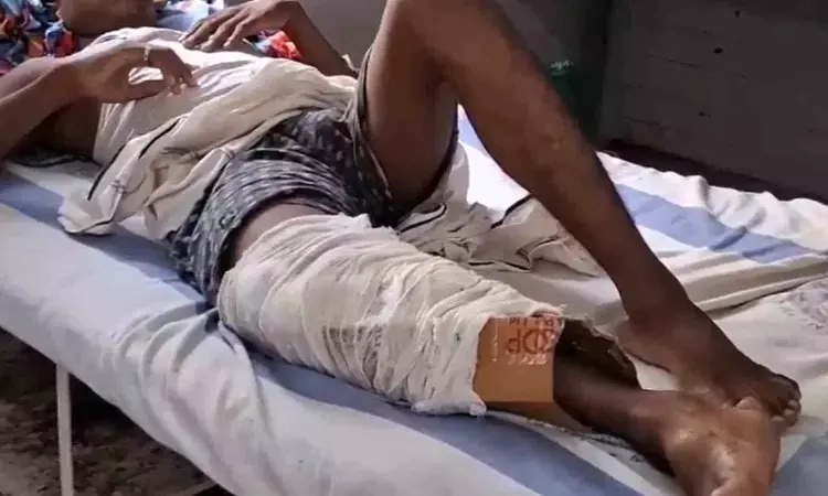 Bihar Health Centre plasters patients fractured leg with cardboard, Video goes viral