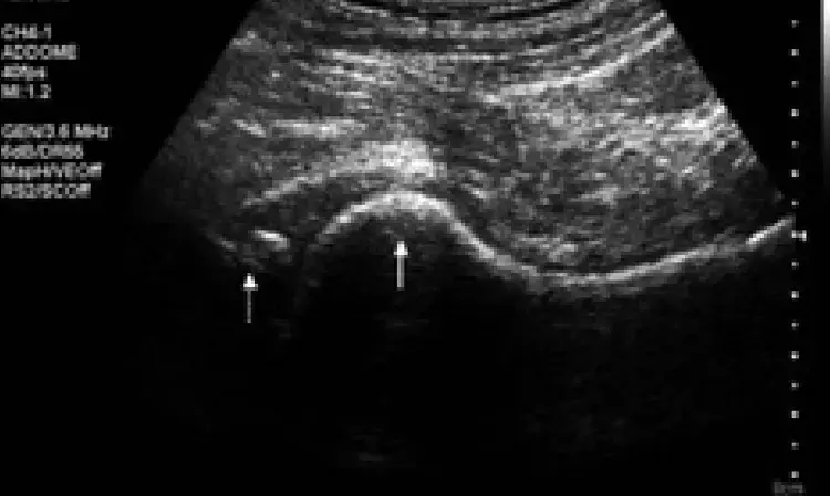 High-frequency ultrasound imaging may predict complications of hypospadias surgery: Study