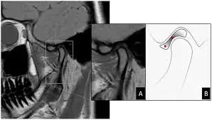 MRI is a reliable tool for the detection of TMJ disc perforations, reveals study