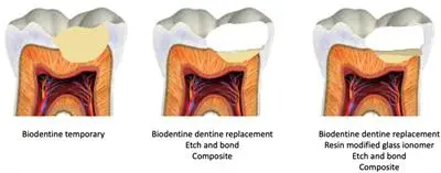 Selective caries removal to soft dentine feasible treatment for deep caries lesions in permanent teeth: Study