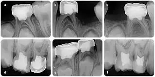 Hyaluronic Acid Promising Alternative in Pediatric Pulpotomy for Primary Molars