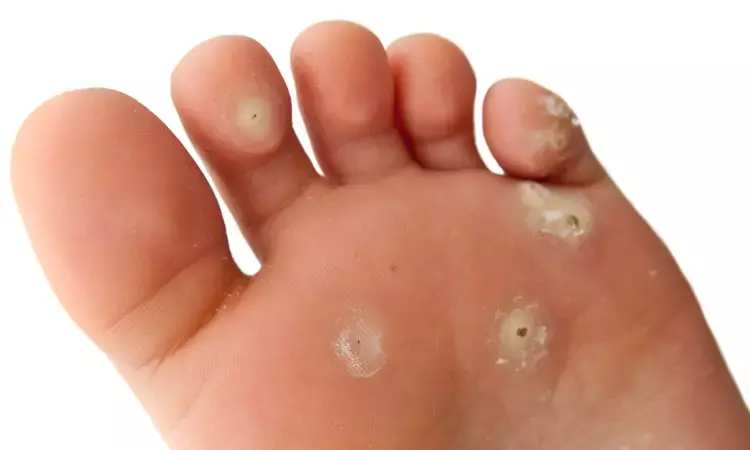 Breakthrough Study: Comparing Plantar Wart Treatments and Ensuring Clear Results with Dermoscopy