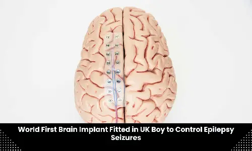 World first brain implant fitted in UK teenager to control epilepsy seizures